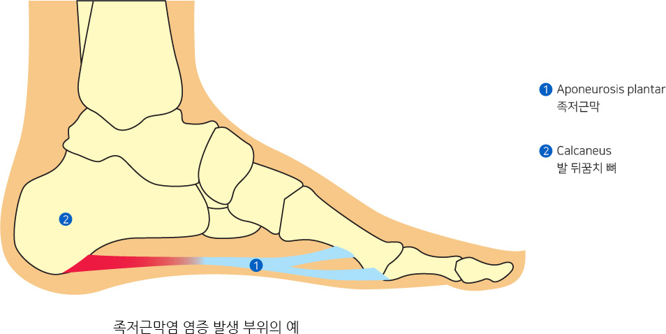 족저근막염 염증 발생 부위의 예,1:Aponeurosis plantar 족저근막,2:Calcaneus 발 뒤꿈치 뼈