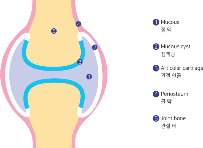 1:Mucous 점액, 2:Mucous cyst 점액낭, 3:Articular cartilage 관절 연골, 4:Periosteum 골막, 5:Joint bone 관절 뼈