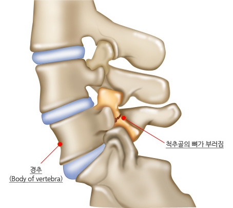경추(Body of vertebra), 척추골의 뼈가 부러짐